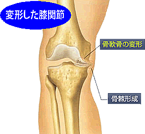膝関節の変形